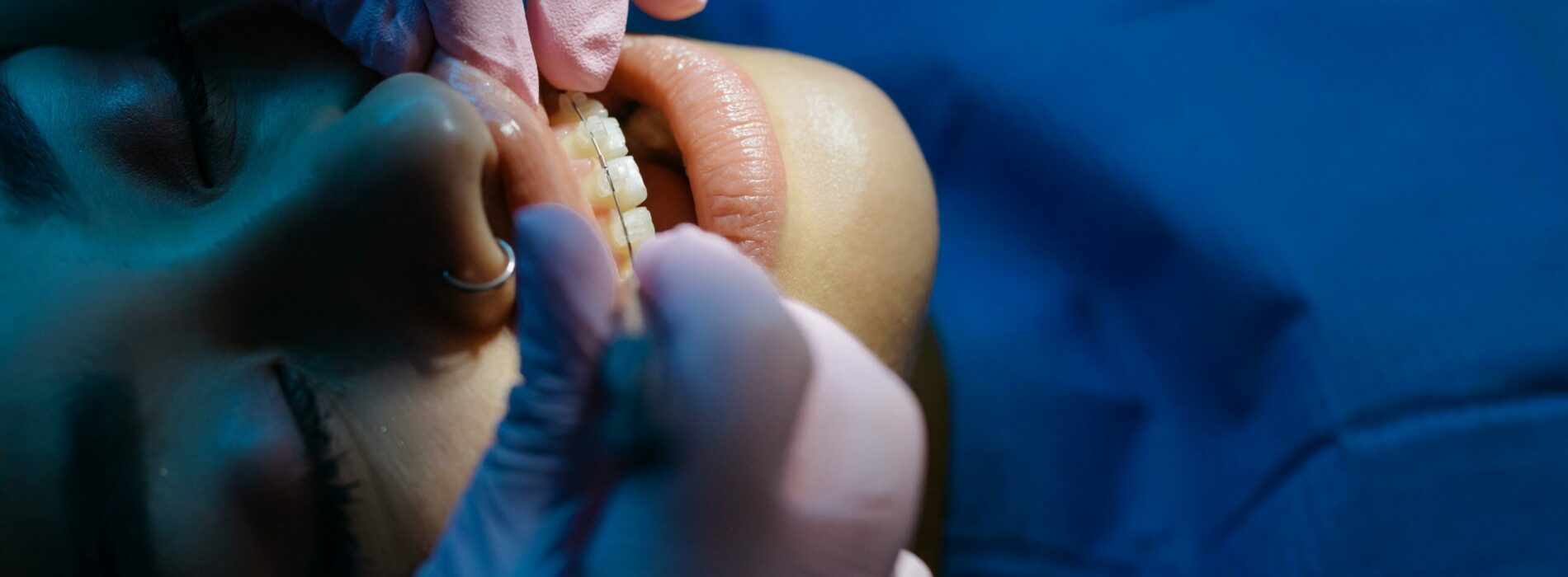 Aparat na jednego zęba – czy się da?
